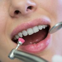 What is A Fluoride Treatment?